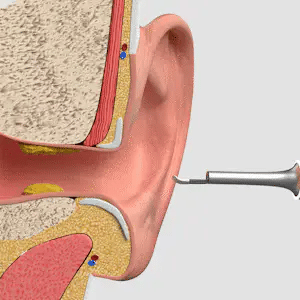 EcloPure® – Nettoyage intelligent des oreilles avec technologie avancée