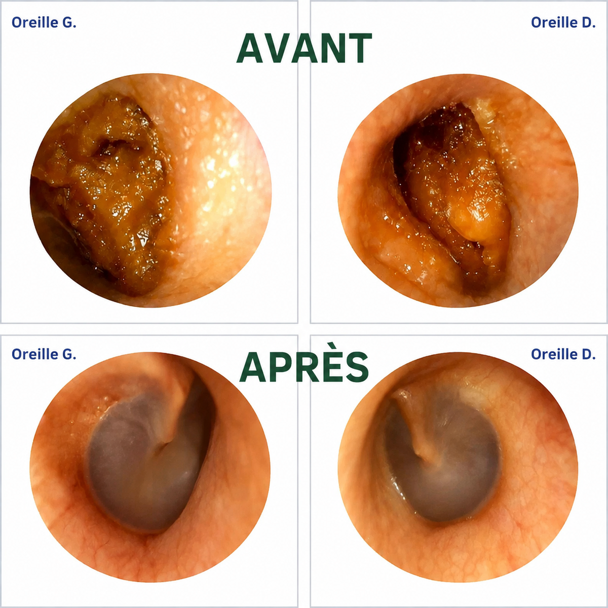 EcloPure® – Nettoyage intelligent des oreilles avec technologie avancée