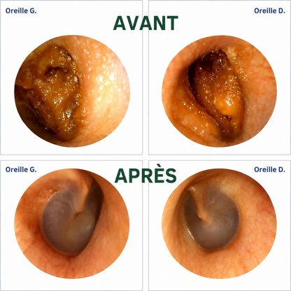 EcloPure® – Nettoyage intelligent des oreilles avec technologie avancée